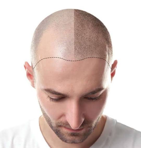 Hair Transplant
